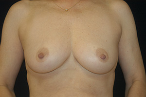 Breast Augmentation 12a